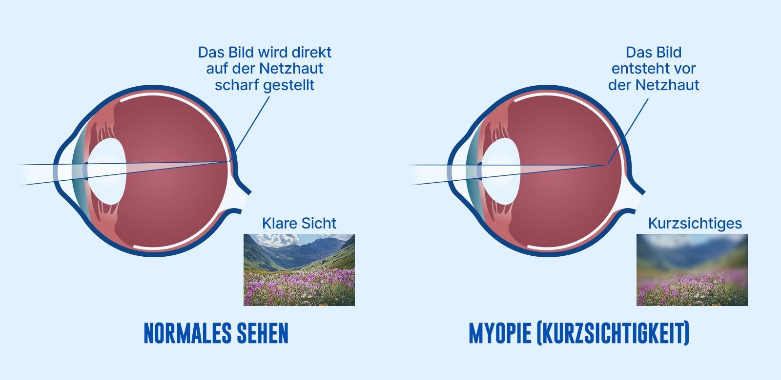 Schema zur Veranschaulichung der Entstehung des Bildes vor der Netzhaut bei einem Unterschied zwischen einem normalen und einem kurzsichtigen Auge: Warum wird die Sicht verschwommen?