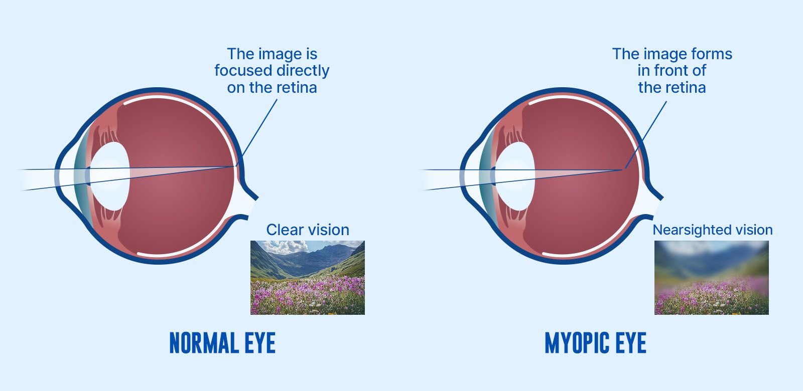 Comparison between a normal eye and a myopic eye showing light focusing