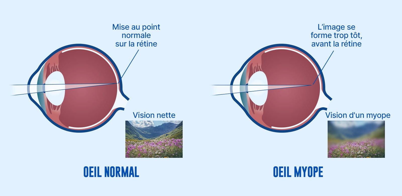 Différence entre un œil normal et un œil myope : pourquoi la vision devient floue ? Comparaison entre un œil normal et un œil myope montrant la focalisation de la lumière